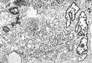 F,68y. | xanthomatous cell in atherosclerotic plaque - a. vertebralis
